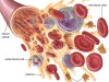 Blood Diseases: White and Red Blood Cells, Platelets and Plasma